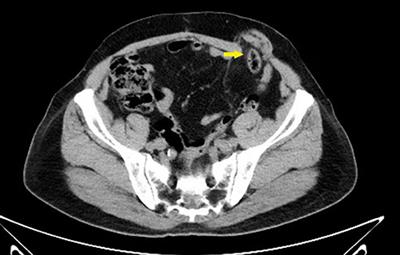 Endoscopic Totally Extraperitoneal Repair of Parastomal Hernia: A Case Report